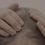 Scalp Micropigmentation for Women