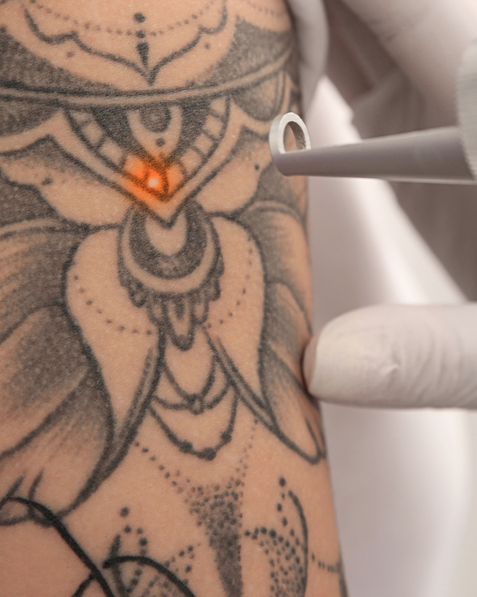 Laser tattoo removal in a private, Port Moody studio